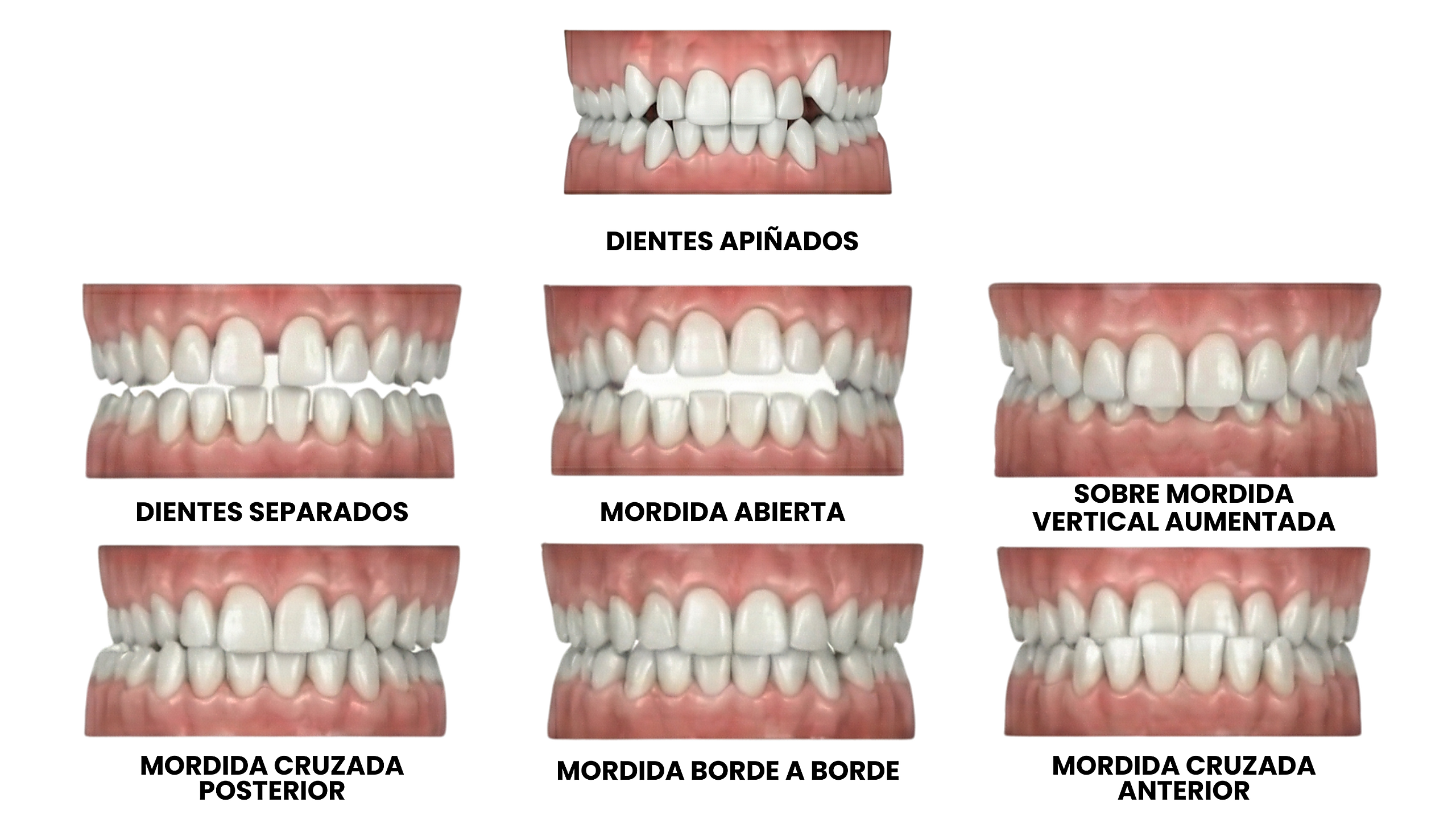 Caso clínico alineadores